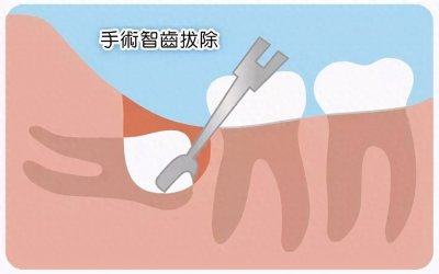 ​不同形态的智齿如何拔除